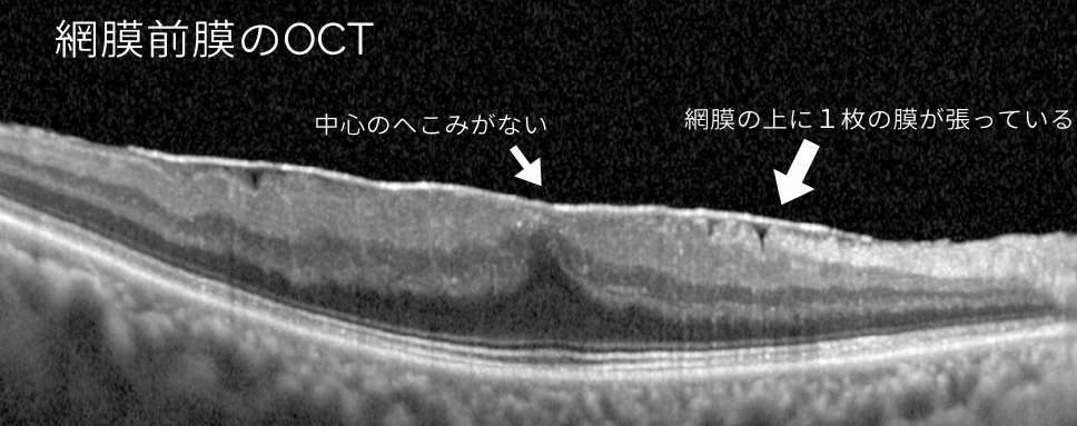 網膜前膜のOCT画像