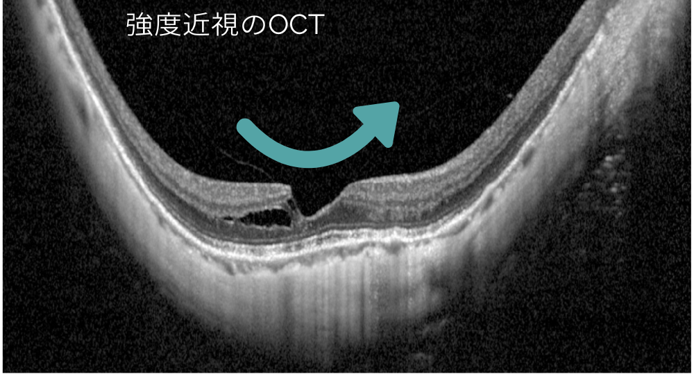 強度近視のOCT画像