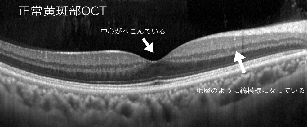 正常の黄斑部のOCT画像