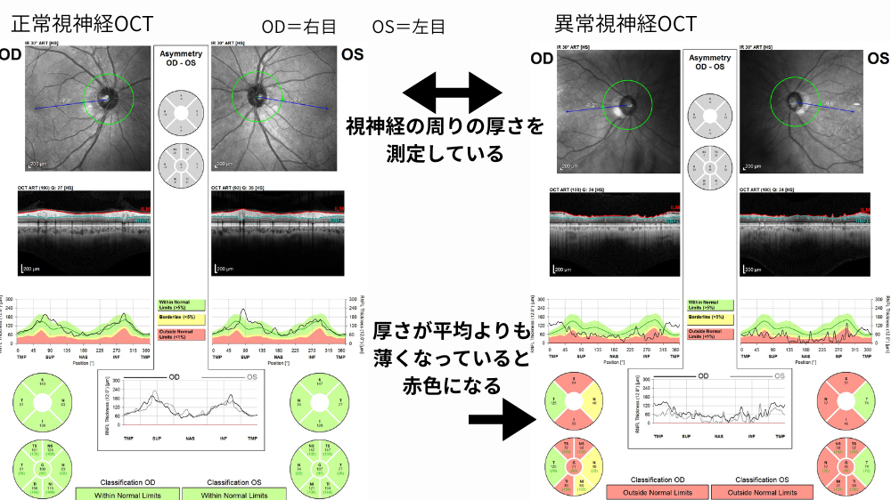 視神経のOCT画像
