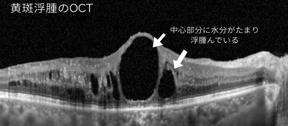 黄斑浮腫のOCT画像
