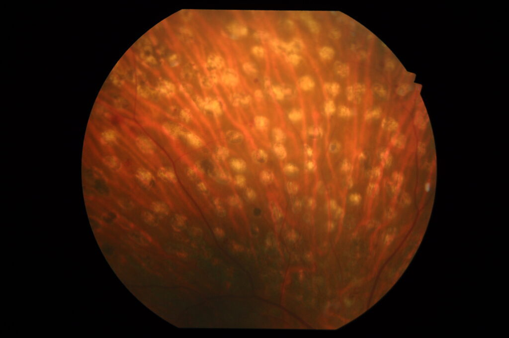 周辺部網膜にレーザー痕のある画像