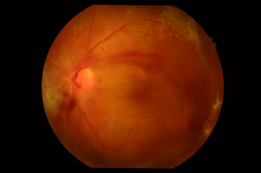 増殖性網膜症の眼底画像
