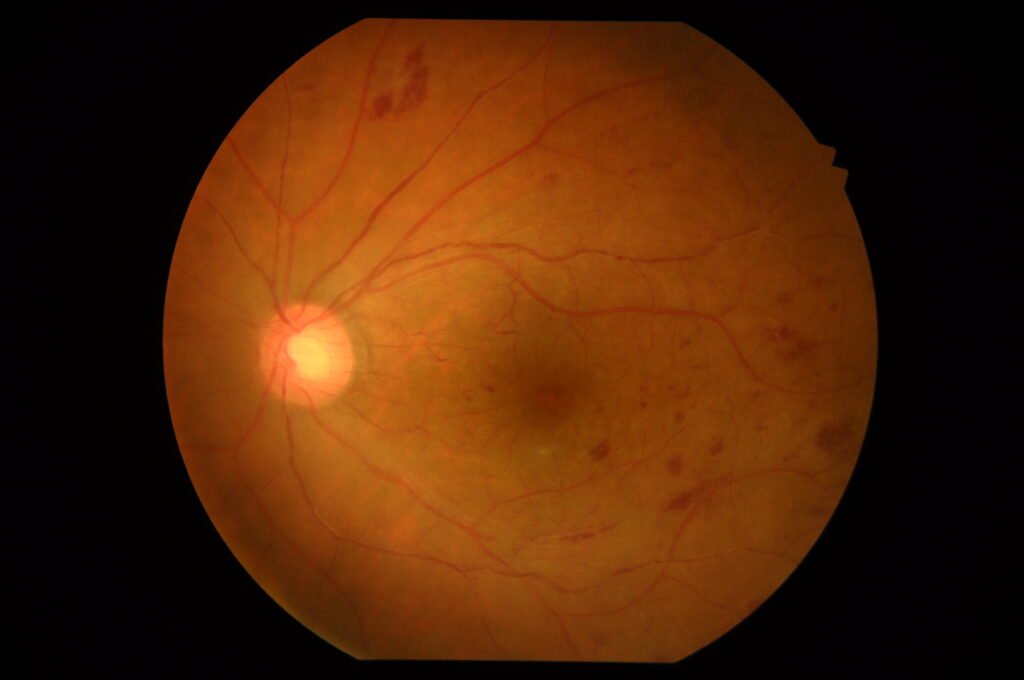 増殖前網膜症の眼底写真