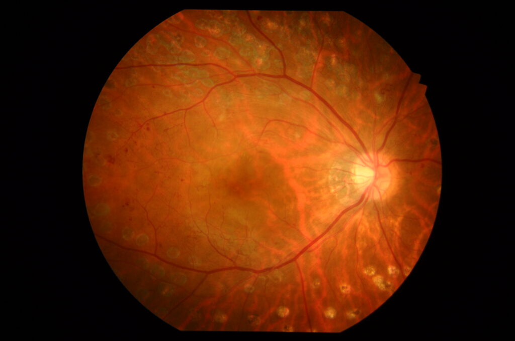 レーザーの痕のある眼底写真