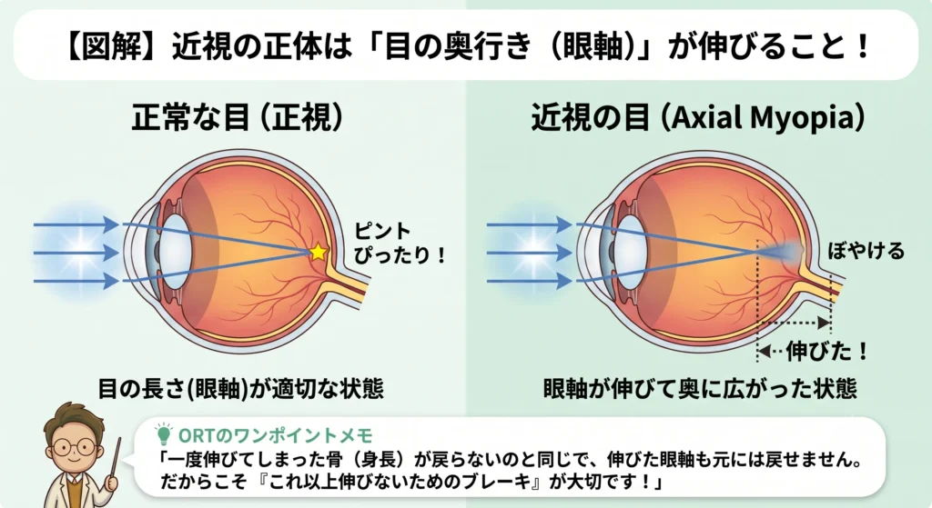 【図解】近視の正体は眼軸（目の奥行き）が伸びること！正常な目と近視の目のピント位置を比較解説したORT監修イラスト